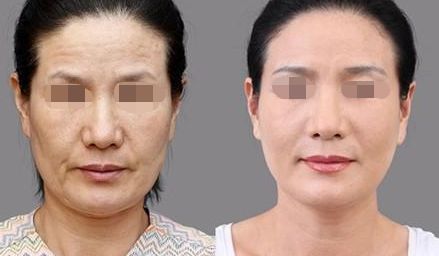 徐州哪家醫(yī)院割雙眼皮效果好？前四名醫(yī)院盤點
