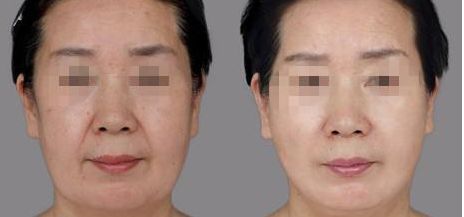 樂山哪家整形醫(yī)院雙眼皮比較好？匯總單六強(qiáng)預(yù)測