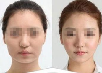 南寧市哪家醫(yī)院做雙眼皮好？