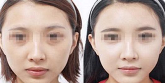 邯鄲哪家醫(yī)院做乳房整形效果好？
