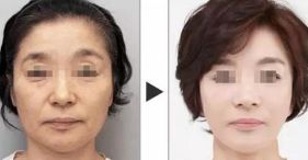 西安哪家醫(yī)院擅長(zhǎng)面部輪廓整形？