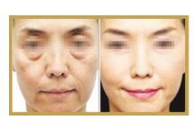 日照哪家醫(yī)院做雙眼皮手術(shù)技術(shù)高效？