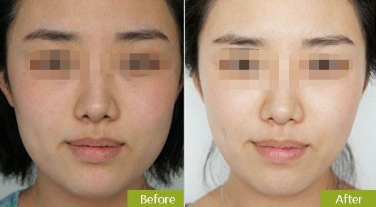 杭州哪家醫(yī)院能夠安全而有效地進(jìn)行隱形矯正？
