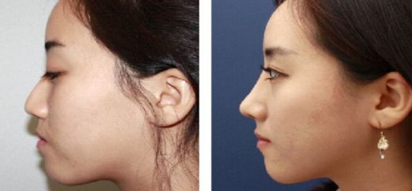 北京大腿抽脂專家推薦，哪個(gè)醫(yī)院技術(shù)好？