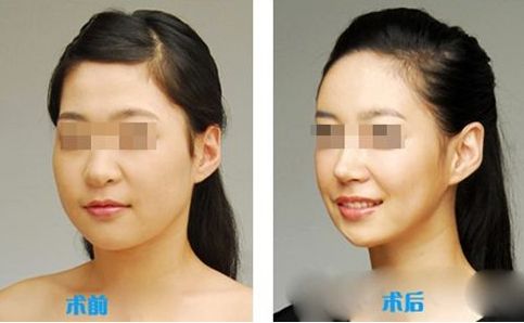 肌功能矯治，哪個(gè)階段適合兒童早期干預(yù)？哪些醫(yī)院堪稱專家？