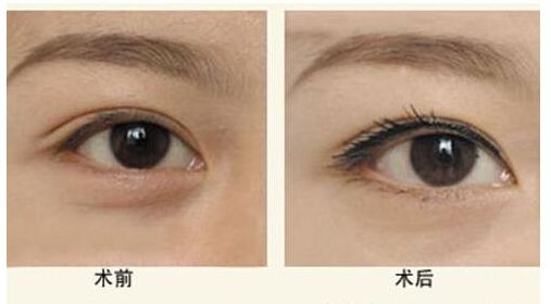 山東哪家醫(yī)院做膨體隆鼻效果好？