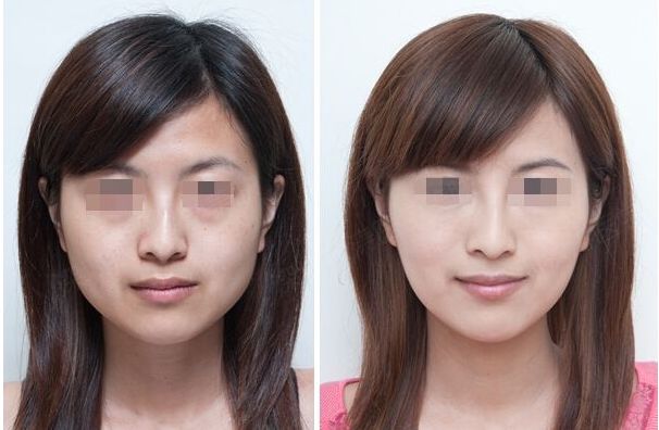 合肥哪家雙眼皮修復(fù)效果好？排名前十的整形醫(yī)院大揭秘