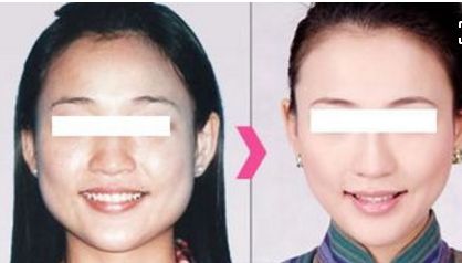 重慶華美分層抗衰超聲炮體驗:效果和醫(yī)生技術分析 重慶華美分層抗衰超聲炮體驗:效果和醫(yī)生技術分析