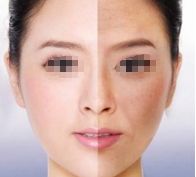 成都做韓式雙眼皮手術哪家醫(yī)院效果最好 成都做韓式雙眼皮手術哪家醫(yī)院效果最好