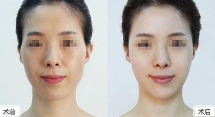 上海割雙眼皮哪家好？佀同帥醫(yī)生實力卓越，口碑實證