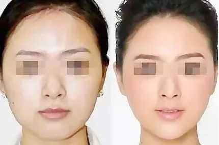 長沙哪個醫(yī)院做雙眼皮最好？