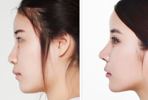 汕頭名流整形醫(yī)院：拉雙眼皮、吸脂價格一覽，專家解讀真實(shí)案例