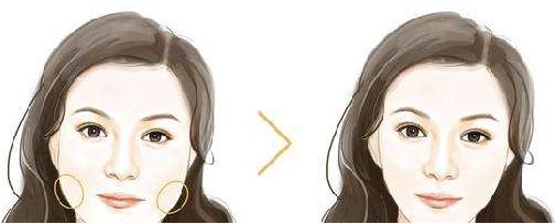佛山生命加整形美容價格大揭秘，張春光元氣美狐眼等你了解