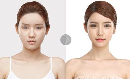北京植發(fā)醫(yī)院推薦，哪家效果好？