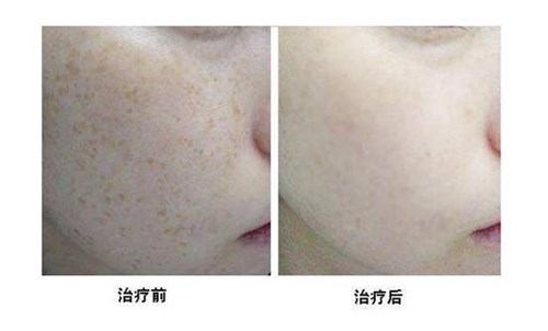 十堰微創(chuàng)手術(shù)去生長紋醫(yī)生