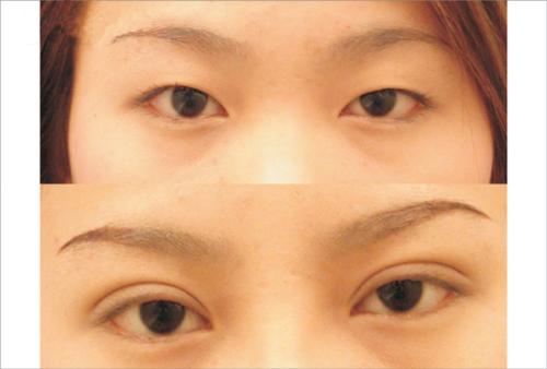 烏魯木齊內(nèi)窺鏡除皺去細紋醫(yī)生