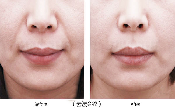 寶雞整容醫(yī)院大整頂級優(yōu)質(zhì)匯總！高一生對決愛容妍_絕對實力的對比震撼