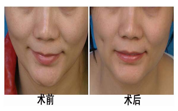 湖州雙眼皮手術(shù)機(jī)構(gòu)推薦：3家優(yōu)質(zhì)醫(yī)院完美整形，放心選擇