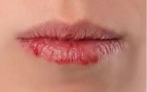 長(zhǎng)沙寬鼻梁矯正醫(yī)生