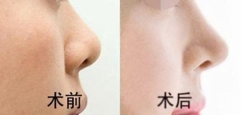 重慶現(xiàn)在有哪些當(dāng)代鼻子整形醫(yī)生值得關(guān)注？參考謝錦清和曾高醫(yī)生的口碑評價