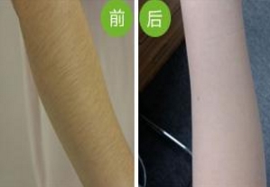哪家南京雙眼皮手術醫(yī)院口碑好？2023年南京韓式雙眼皮手術前十名排序！
