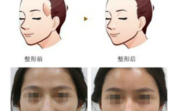 洛陽哪家醫(yī)院做木偶紋效果好？2023榜單出爐，洛陽物理去木偶紋top10佳選露面！