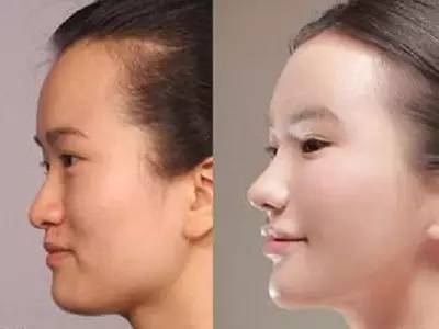 2023年，哪些上海自體脂肪面部精雕整形醫(yī)院的口碑特別好？排名榜前十值得信賴的美容整形醫(yī)院！
