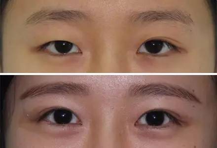 杭州駝峰鼻矯正哪家整形醫(yī)院技術(shù)獨特？2023杭州駝峰鼻矯正排名前10的醫(yī)院評測揭曉！