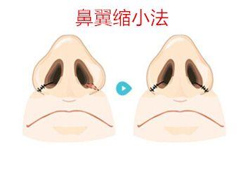 2023成都極具聲望的木偶紋填充玻尿酸醫(yī)療中心排行榜！驚喜揭曉