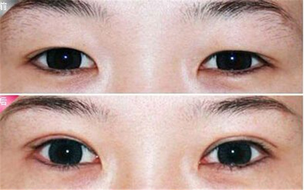 杭州哪家整形醫(yī)院效果好，專業(yè)解決祛痘坑痘印問題，2023很受歡迎的前十家！