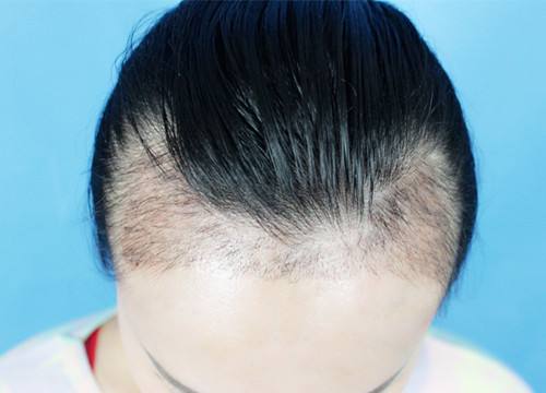 宜賓市哪家整形醫(yī)院專業(yè)豐額頭術(shù)效果好？探尋宜賓自體脂肪豐額頭術(shù)醫(yī)院口碑佳！2023宜賓豐額頭術(shù)推薦前十技