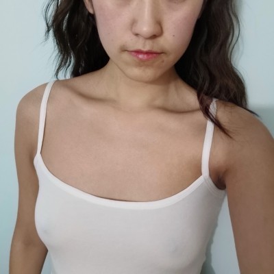 廣州韓妃整形美容醫(yī)院復合豐胸（假體+自體脂肪）100天效果反饋