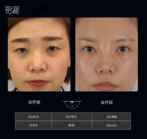 阿爾法9°美眼，打開視界，美無止境