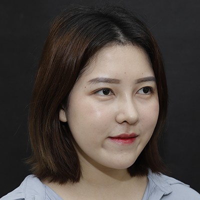 廣州美恩半肋鼻手術恢復效果反饋，主任親自操刀的效果就是贊！