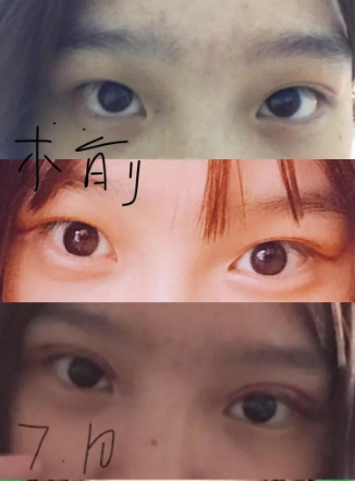 做雙眼皮案例，濟(jì)南坤如瑪麗崔金珍雙眼皮案例圖片
