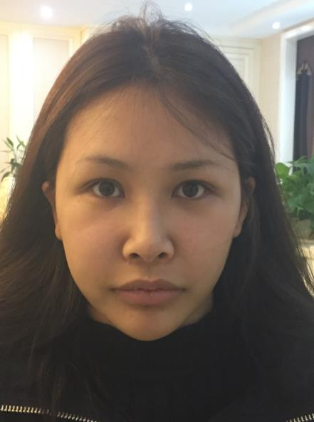 長春中研整形黃帝云鼻頭縮小術后三個月效果反饋圖