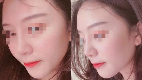 耳軟骨隆鼻術(shù)后三個月，我有了韓佳人同款美鼻