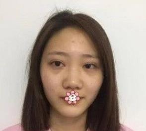 北京彤美耳軟骨隆鼻案例分享術(shù)前效果