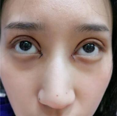 雙眼皮失敗丑的不敢見人，昆明麗都整形雙眼皮修復(fù)案例分享