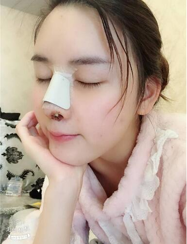 北京哪家隆鼻好？花一萬鼻子做成這樣值不值