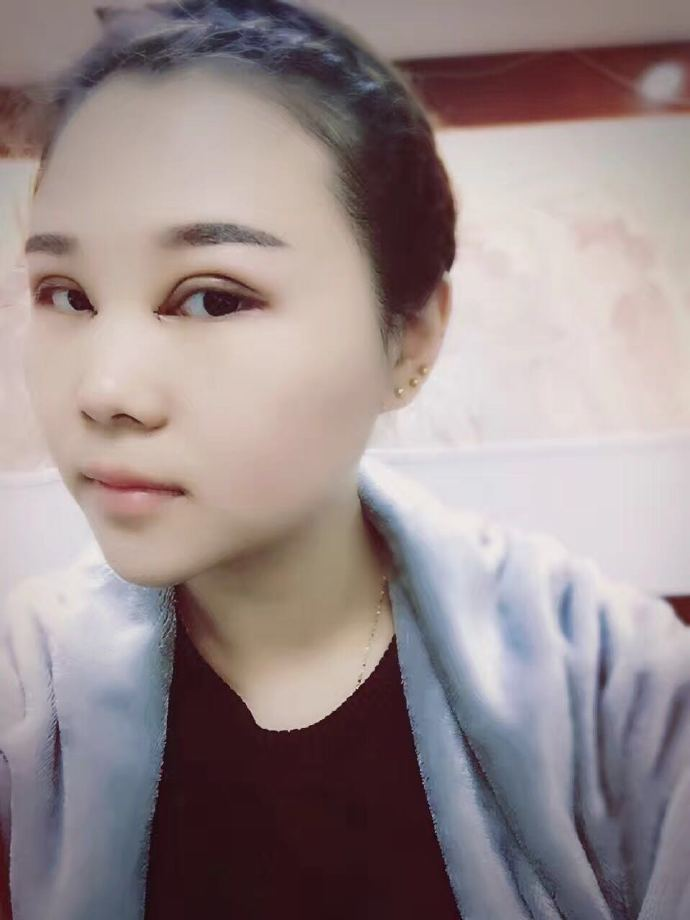 腫眼泡應(yīng)該做哪種雙眼皮？汕頭曙光雙眼皮三個(gè)月效果分享