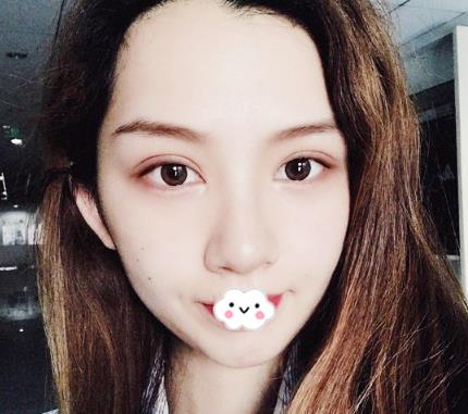 武漢伊萊美割雙眼皮案例分享術(shù)后半個月效果