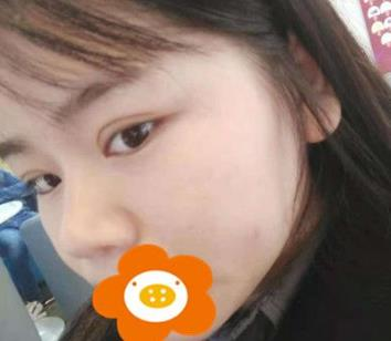 據(jù)說(shuō)杭州薇琳隆鼻后效果很自然，有案例嗎