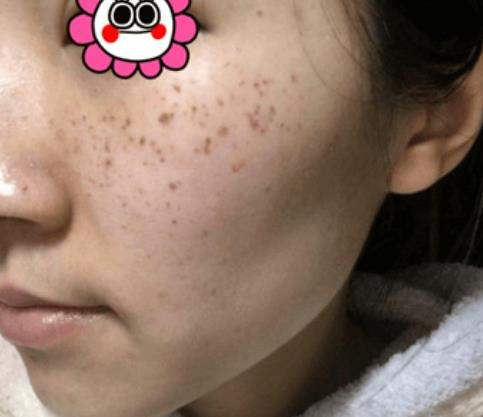 困惱我多年的斑，沒想到在溫州韓美三千塊錢就去掉了