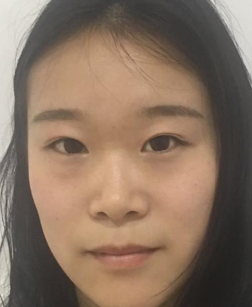 石家莊諾萬整形肋軟骨隆鼻案例術前效果