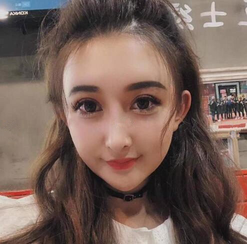 深圳陽光全臉填充術(shù)前術(shù)后對比，說年輕十歲不過分吧