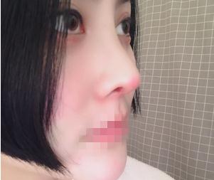 重慶星范整形超體隆鼻半個(gè)月效果
