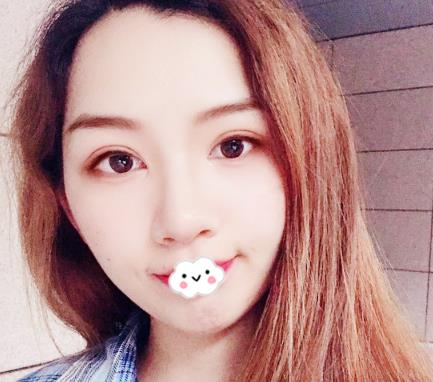 武漢伊萊美割雙眼皮怎么樣？切開(kāi)雙眼皮恢復(fù)過(guò)程圖