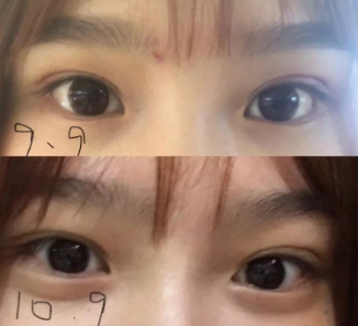 做雙眼皮案例，濟(jì)南坤如瑪麗崔金珍雙眼皮案例圖片