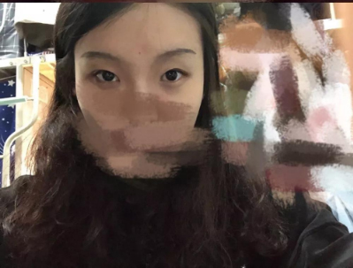 做雙眼皮案例，北京藝星張順慶雙眼皮案例圖片